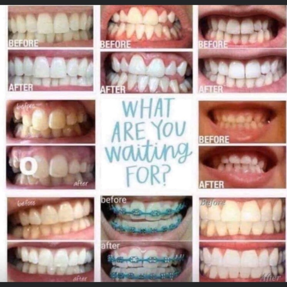 Tooth whitening